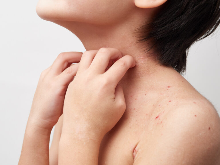 TREATkids-Register bei der atopischen Dermatitis