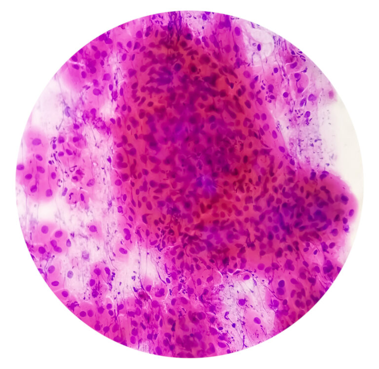 Transkripttypen, molekulares Ansprechen und Biomarker auf dem Prüfstand