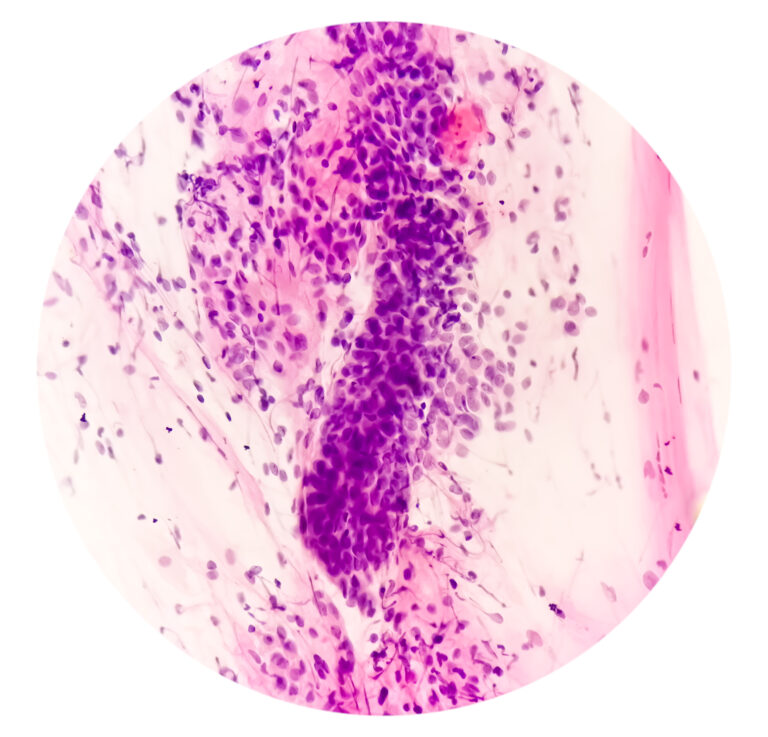 Evidenzbasierte Empfehlungen zu Diagnose und Therapie