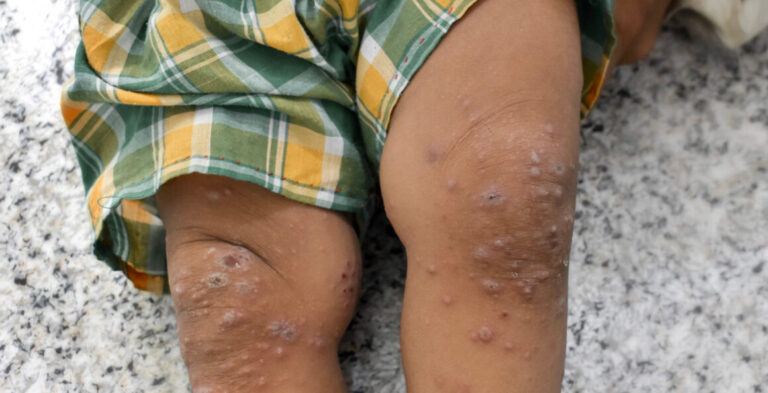 Permethrin kombinieren und bei Therapieversagen Alternative prüfen